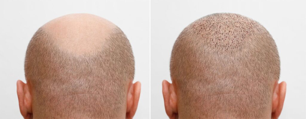 hair transplant 3