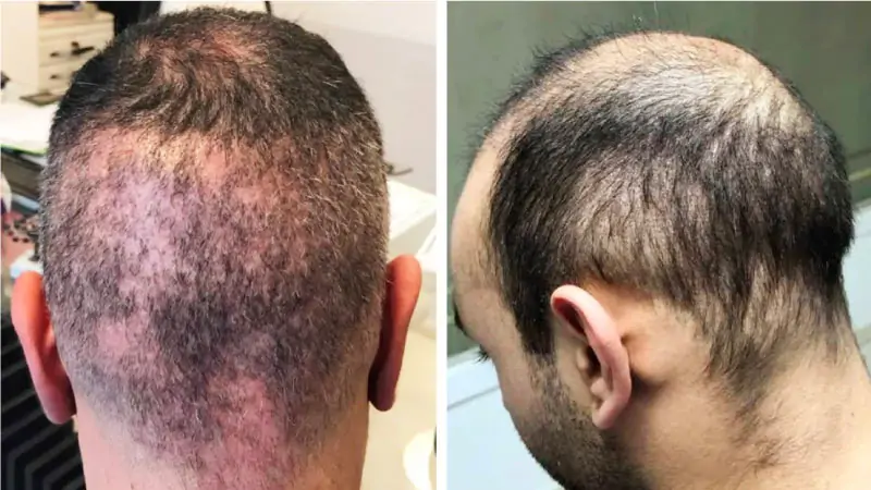 Hair Transplant Over Harvesting: Risks, Signs and Repair Options 3 hair transplant over harvesting