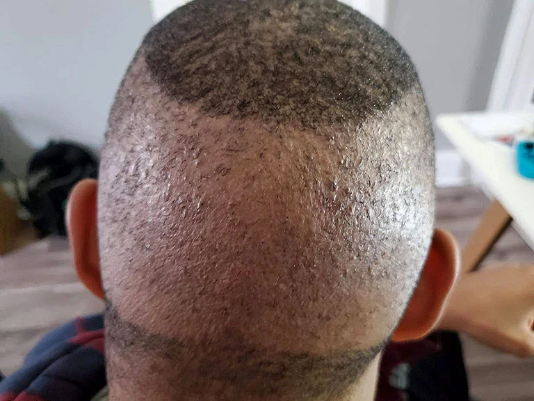 Hair Transplant Over Harvesting: Risks, Signs and Repair Options 2 hair transplant over harvesting