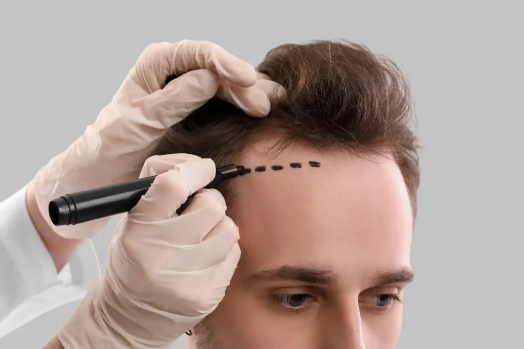 hair transplant preparation