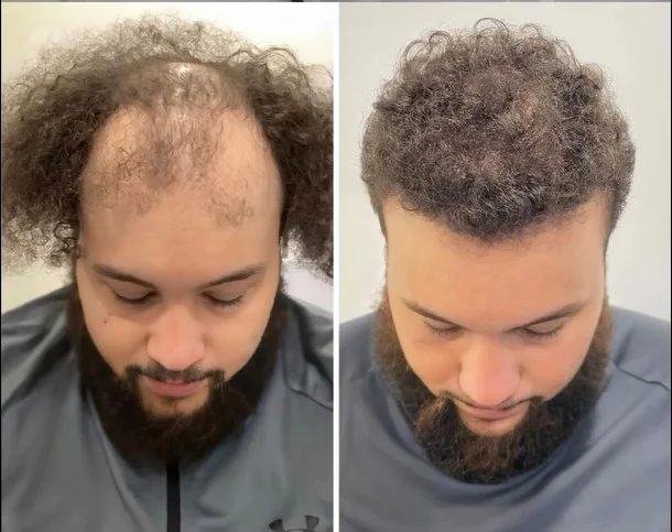 hair transplant turkey