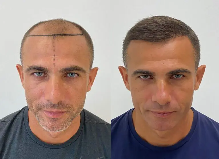 hair transplant turky