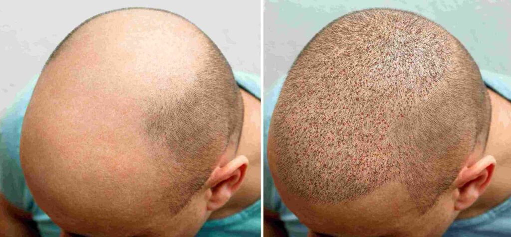 hair transplantation in istanbul turkey