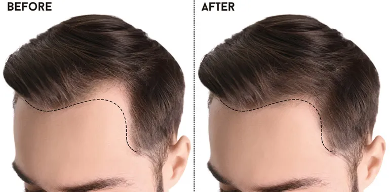 Wie Wird Der Haaransatz Bei Einer Gestaltung des Haaransatzes? 3 hairline design before after