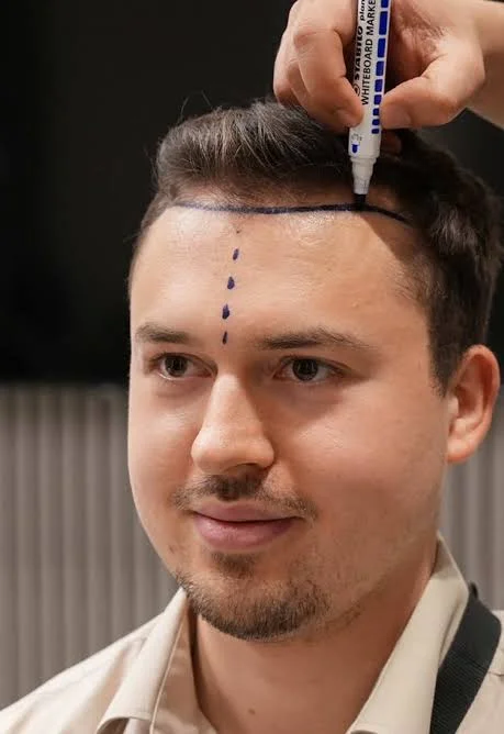Wie Wird Der Haaransatz Bei Einer Gestaltung des Haaransatzes? 2 hairline design