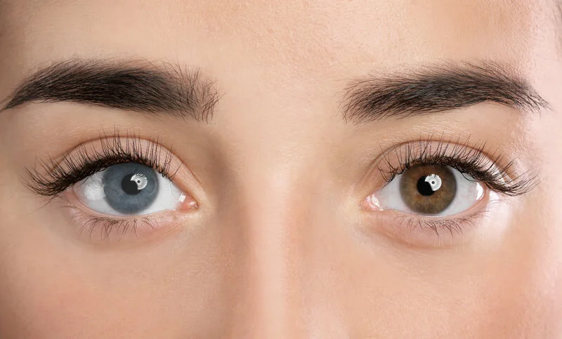 heterochromia