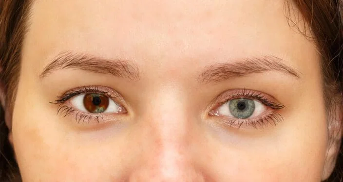 heterochromia