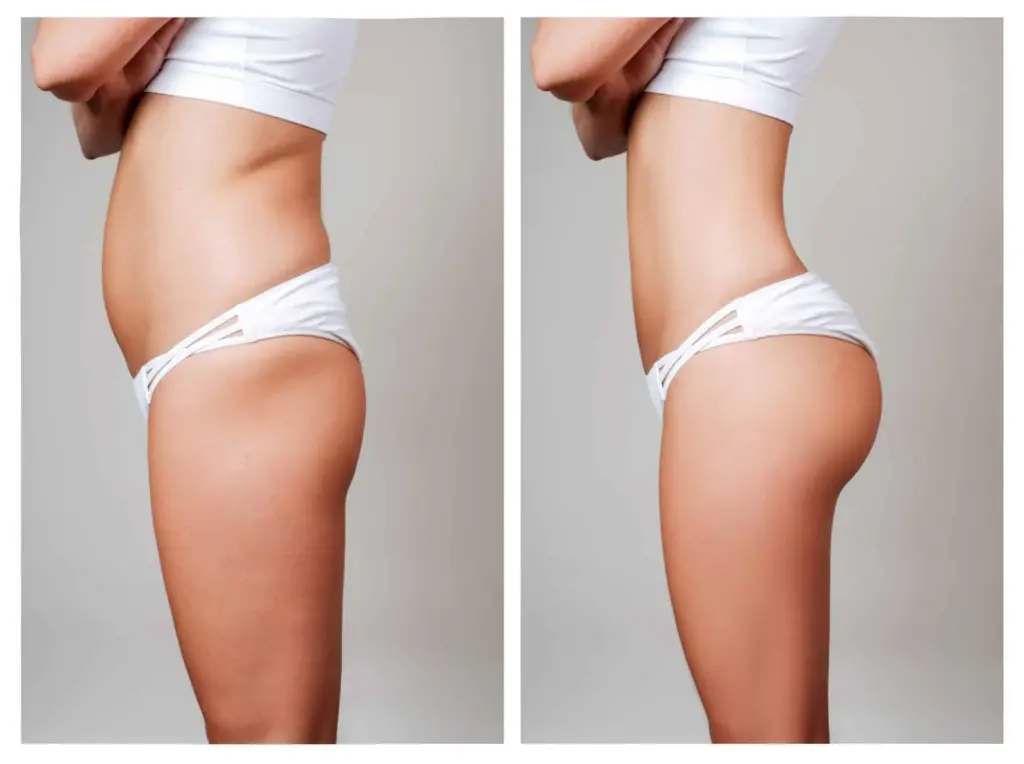 Kalça Çukuru Estetiği (Hip Dip): Yağ Enjeksiyonu, İyileşme ve Fiyatlar 3 hip dip surgery