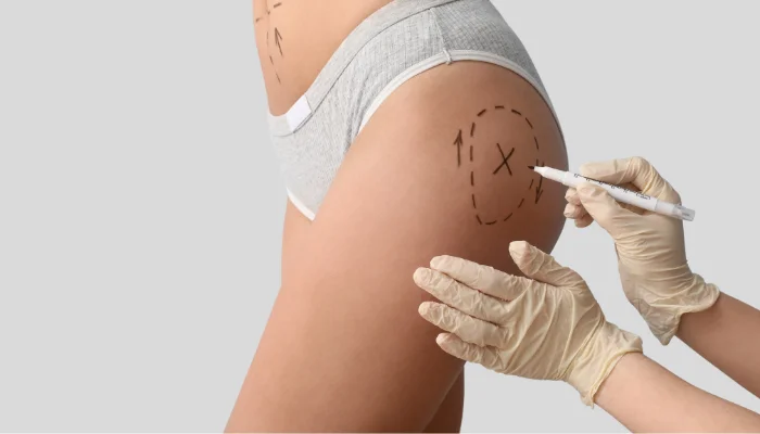 Kalça Çukuru Estetiği (Hip Dip): Yağ Enjeksiyonu, İyileşme ve Fiyatlar 1 hip dip surgery cost