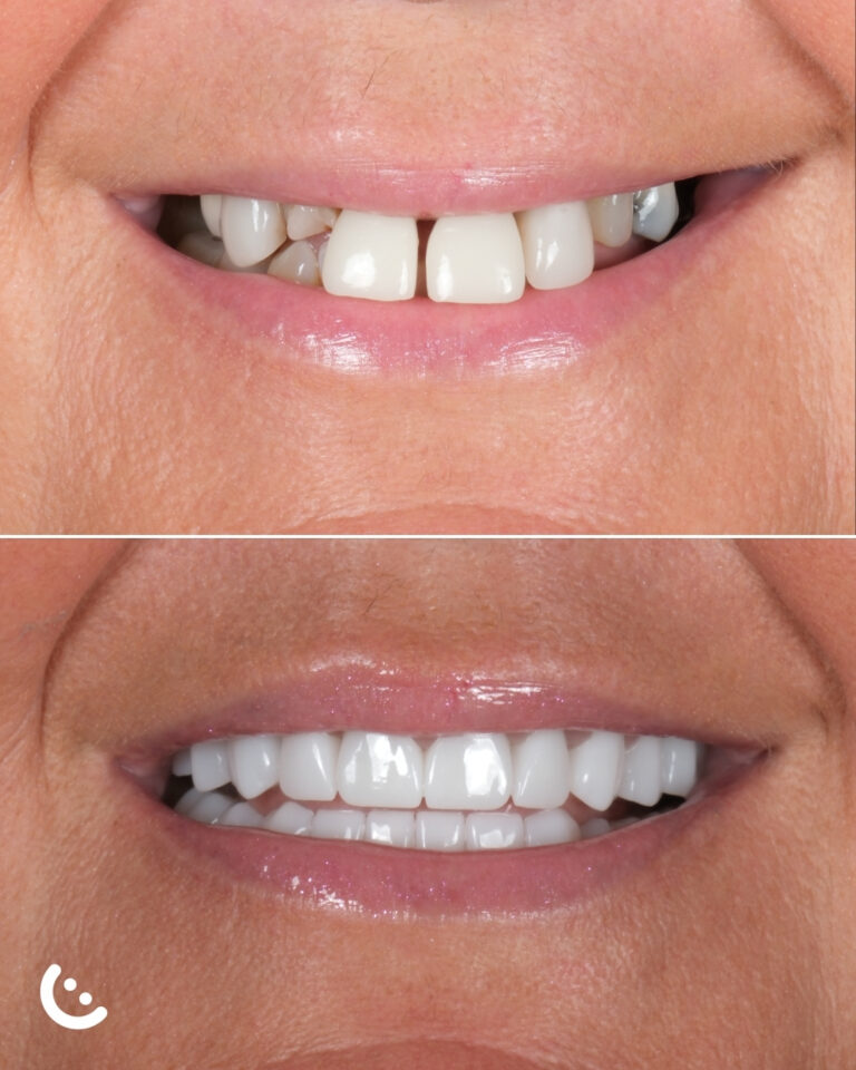 hollywood smile in turkey befor after