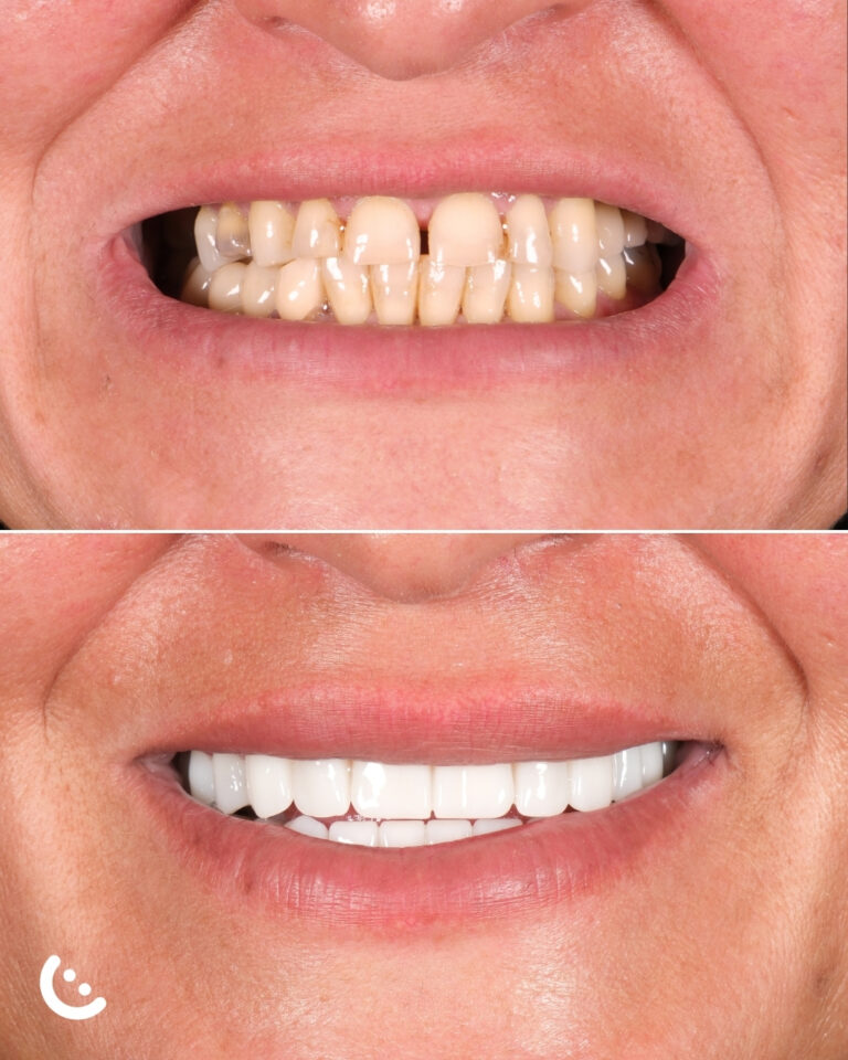 hollywood smile turkey before after