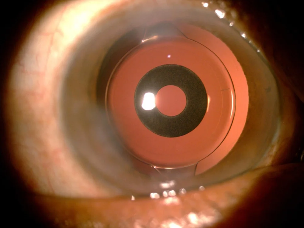 Was ist eine multifokale IOL? Was ist ihr Zweck? 2 how does a multifocal IOL work