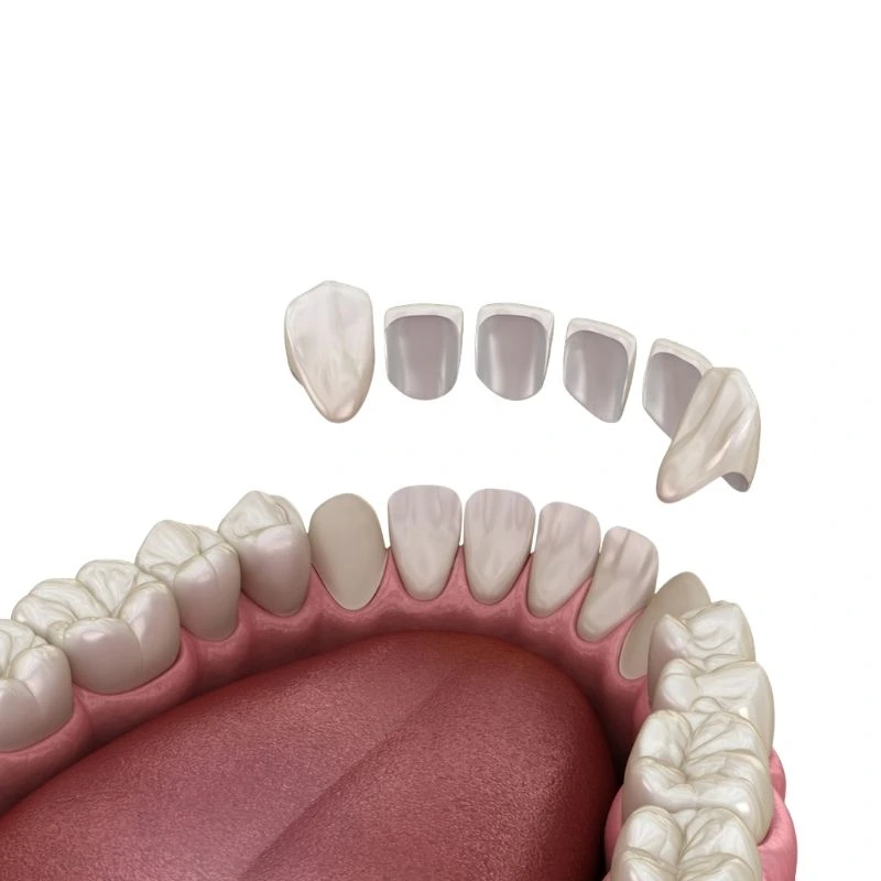 how long does it take to get a dental crown fitted
