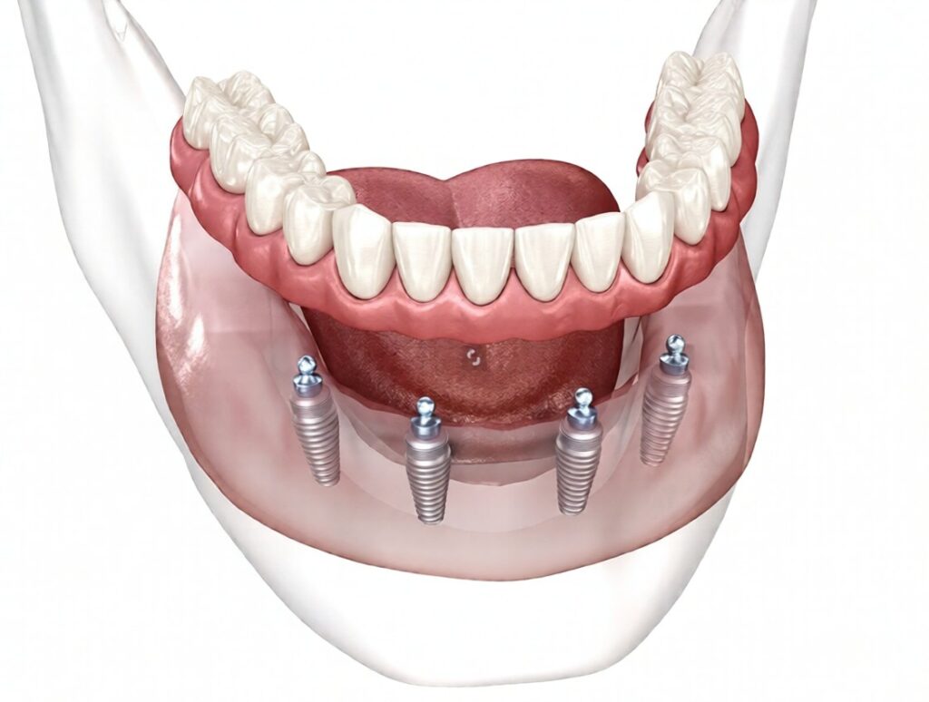 how many dental implants can be placed in one session