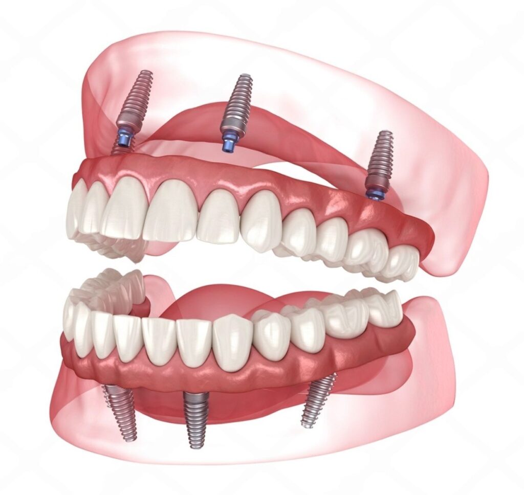 how many dental implants in one session