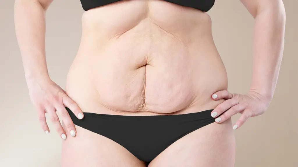 how to get rid of loose skin after weight loss