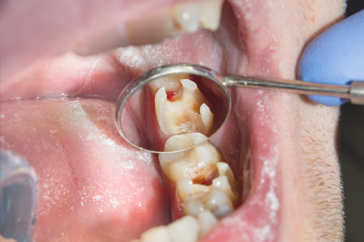 how to get rid of tooth sensitivity