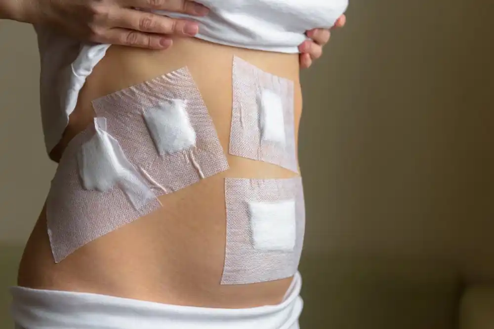 how to prevent gallstones after bariatric surgery