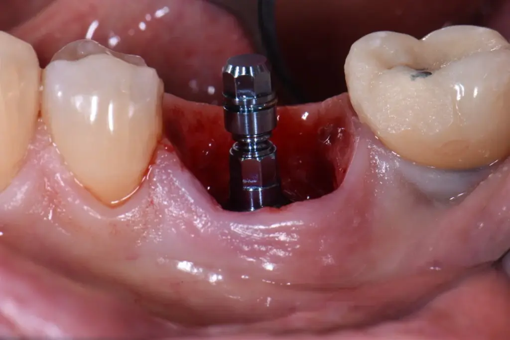 immediate dental implant