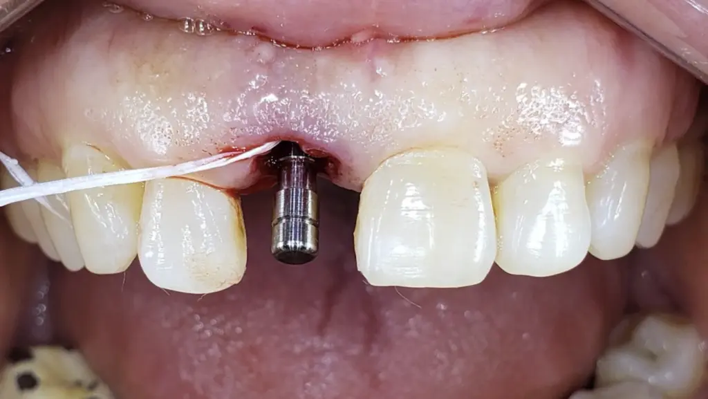 immediate dental implant