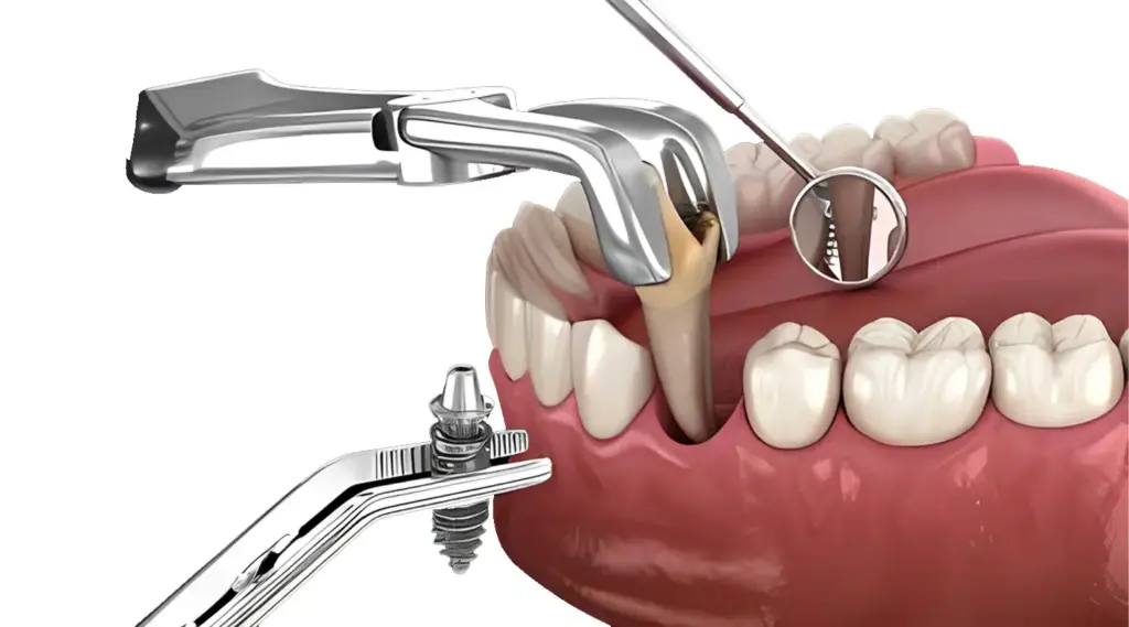 immediate dental implant