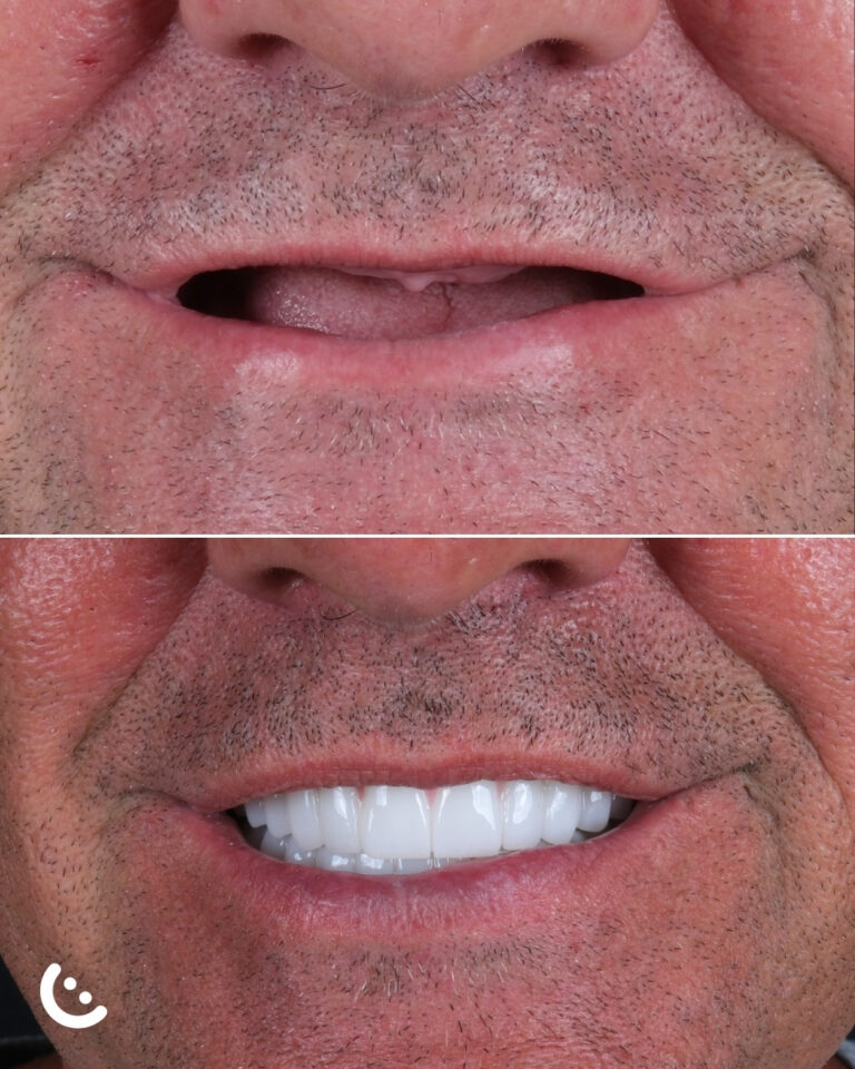 implants in turkey before after