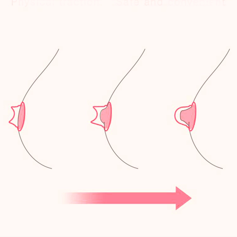 Operatie aan Ingetrokken Tepels: Herstel, Borstvoeding & Kosten 2 inverted nipple surgery