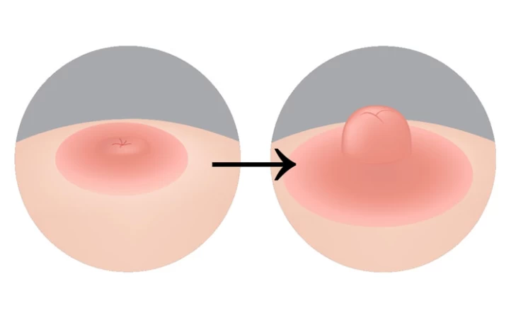 Operatie aan Ingetrokken Tepels: Herstel, Borstvoeding & Kosten 1 inverted nipple surgery before after
