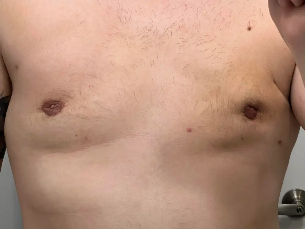 Operatie aan Ingetrokken Tepels: Herstel, Borstvoeding & Kosten 3 inverted nipple surgery cost