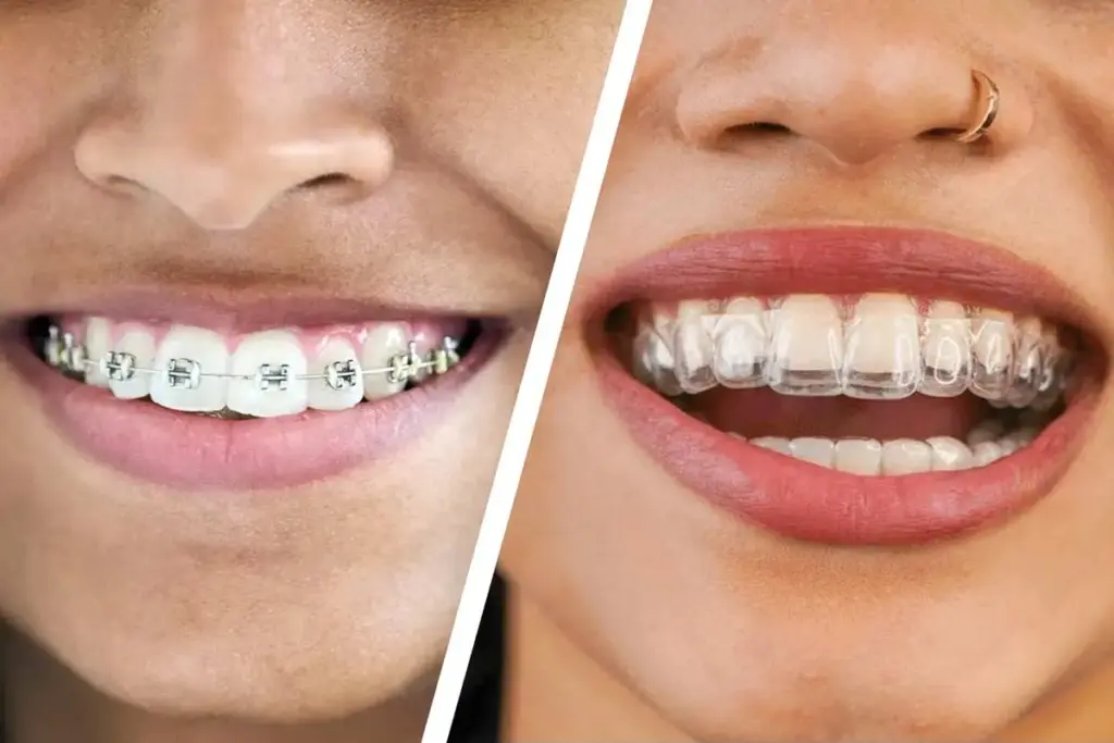 Invisalign vs Braces: Cost Factors, Speed, Results & Teens 1 invisalign vs braces