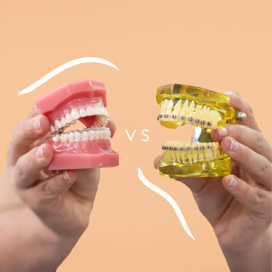 Invisalign vs Braces: Cost Factors, Speed, Results & Teens 3 invisalign vs braces which is faster