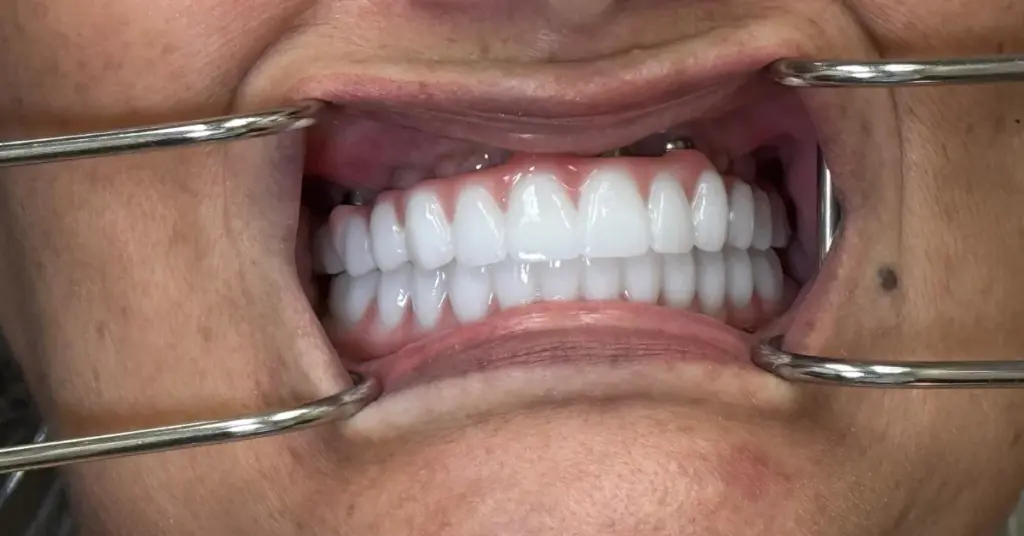 Is Metallic Taste After Dental Implant Normal? Causes & Fixes 2 metallic taste after dental implant