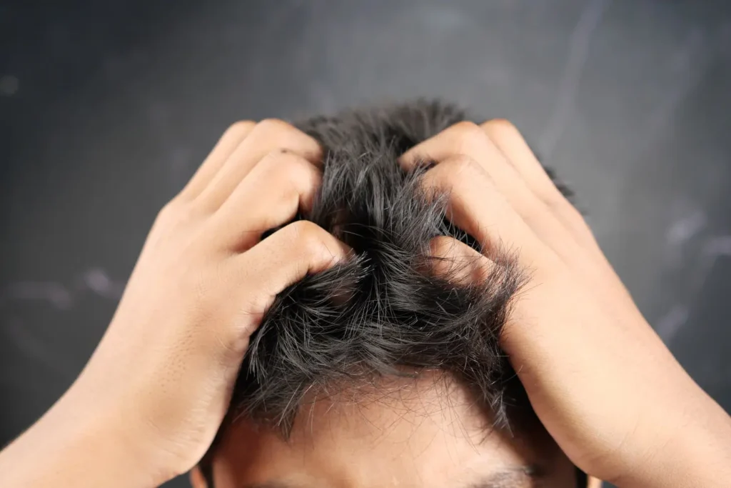 Saç Ekimi Sonrası Kaşıntı: Nedenleri, Süresi ve Tedavisi 3 itching after hair transplant