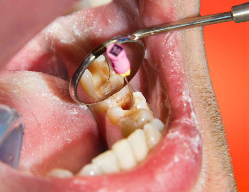 kanal tedavisi mi dis cekimi mi