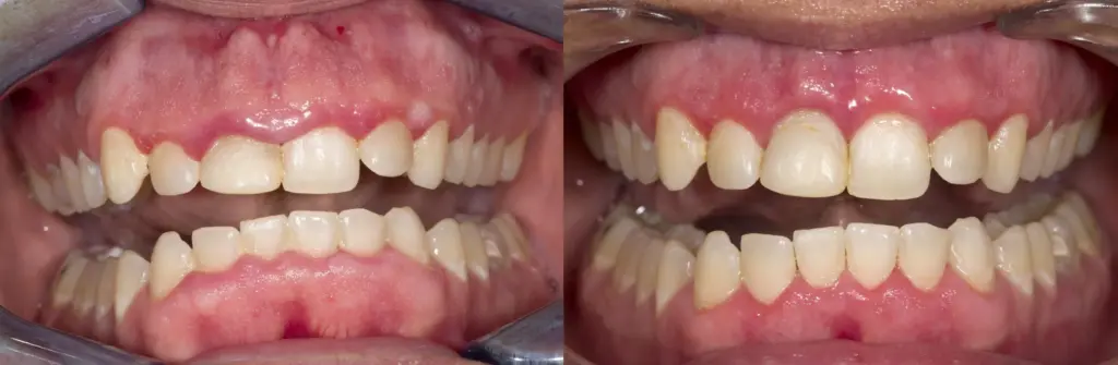 laser gingivectomy before after