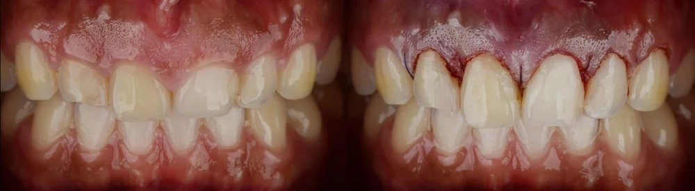 laser gingivectomy