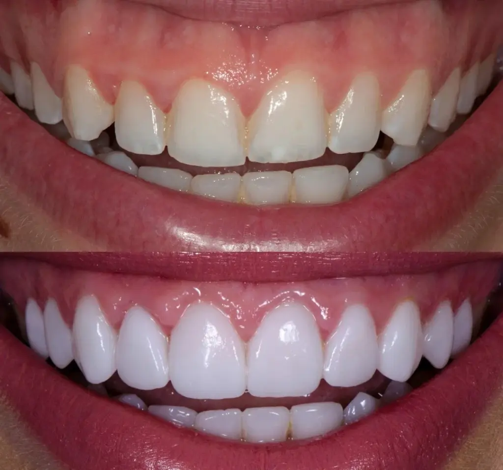laser gum contouring