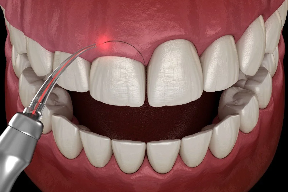 laser gum contouring