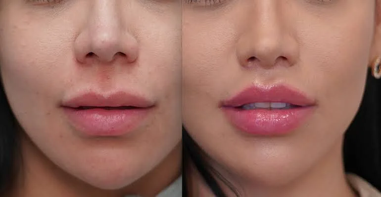 lip lift surgery before after