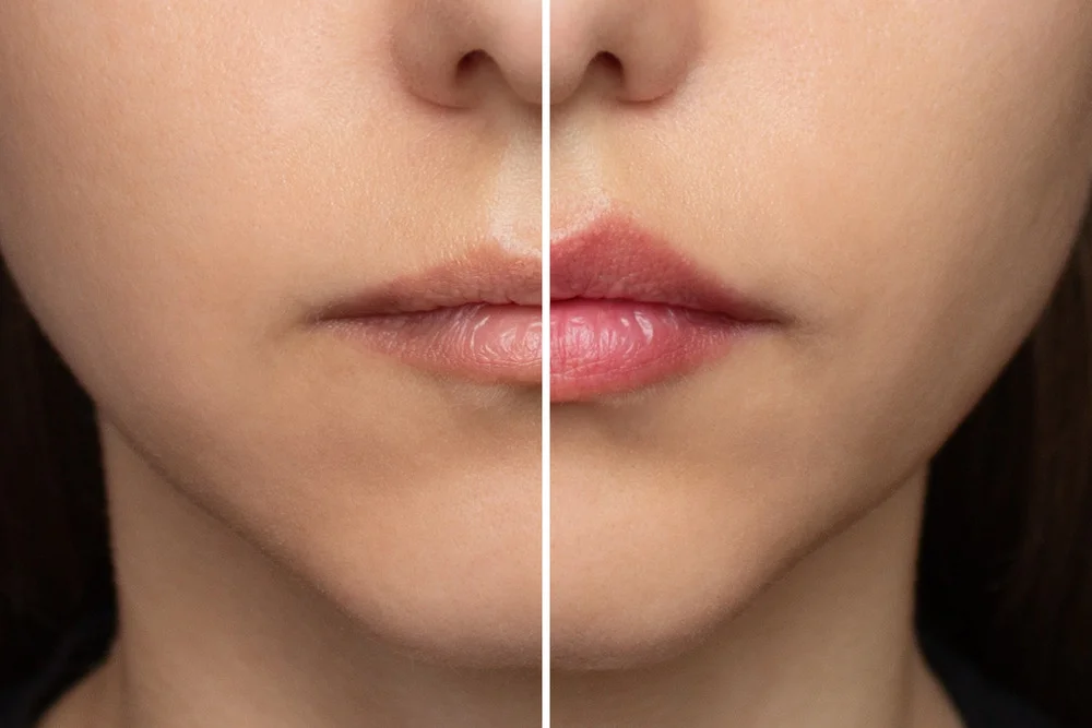 lip lift surgery