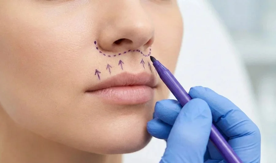 lip lift surgery