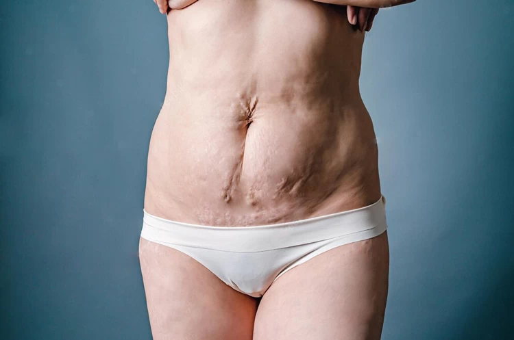 liposuction side effects