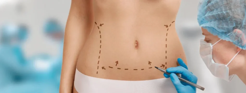 liposuction surgery
