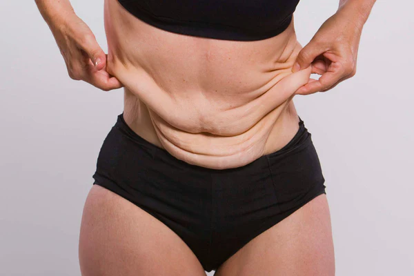 loose skin after weight loss gastric bypass