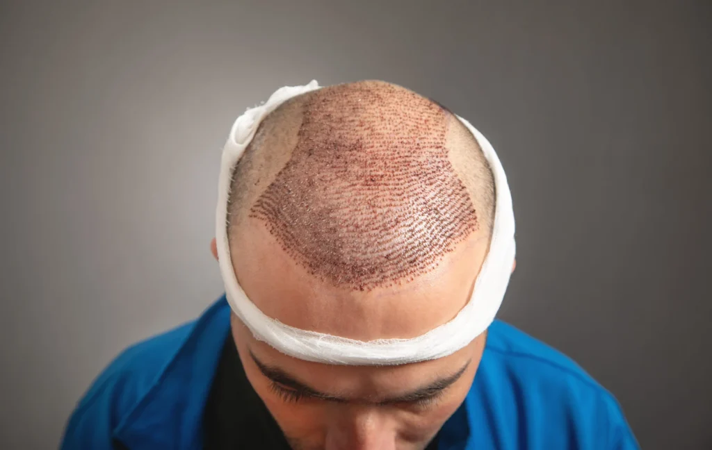 man after hair transplantation