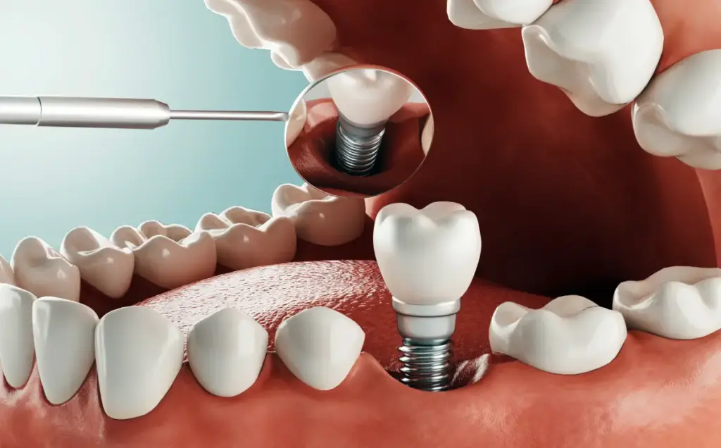 Is Metallic Taste After Dental Implant Normal? Causes & Fixes 3 metallic taste after dental implant