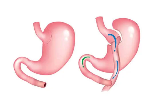 mini gastric bypass