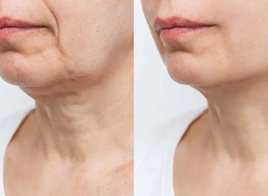 neck lift before after