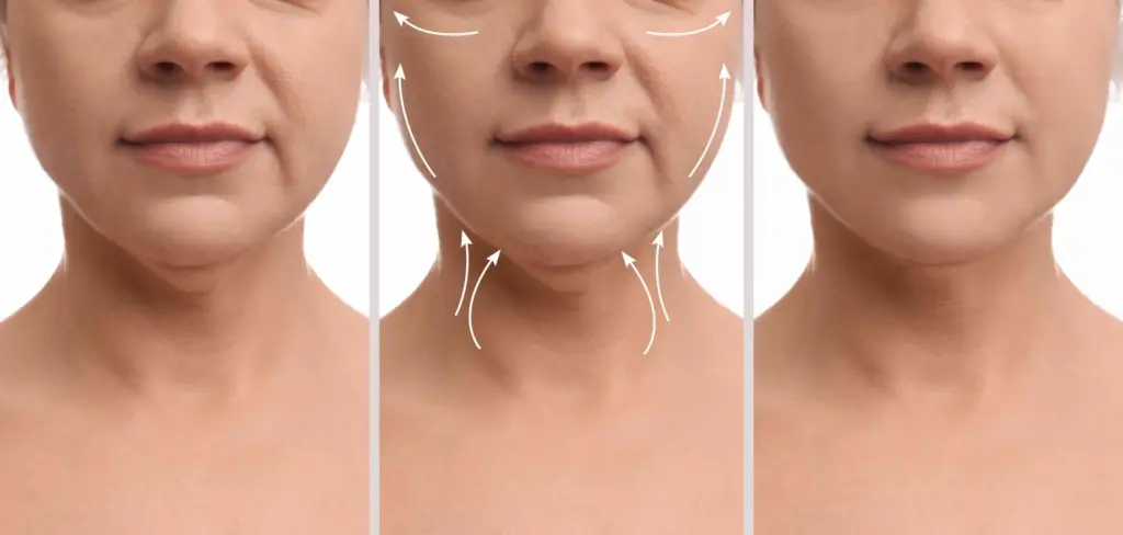 neck lift surrgery