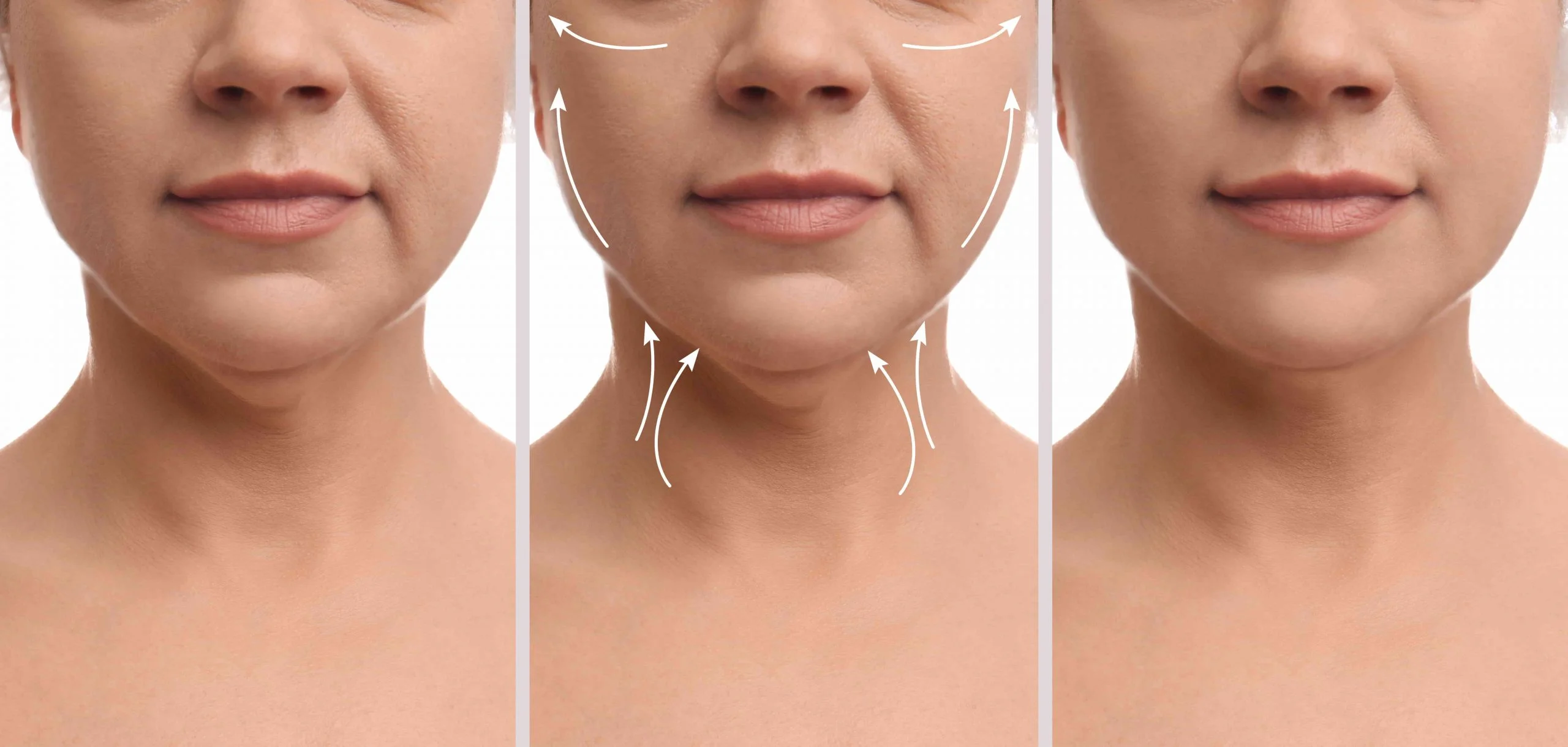 neck lift surrgery